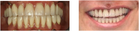 "Implantes-dientes-en-un-dia7.jpg"