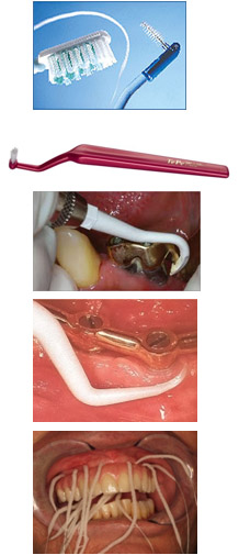 Mantenimiento-implantes1.jpg