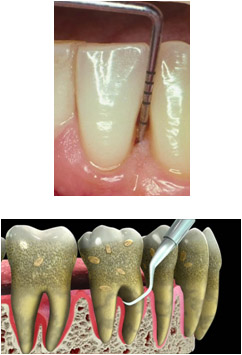 Tratamiento-periodontal-continuado.jpg