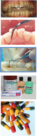 Control-infeccion-periodental-1.jpg