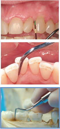 Fase-mantenimiento-periodental1.jpg