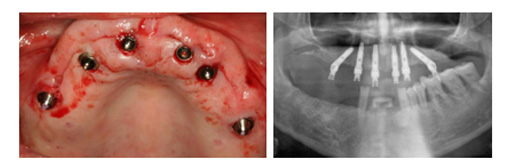 Implantes-sin-cirugia1.jpg