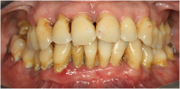 Periodontitis-1.jpg