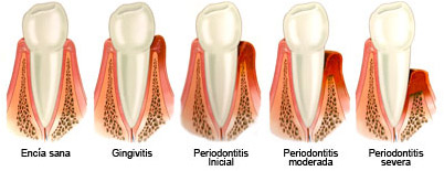 Periodontitis-2.jpg
