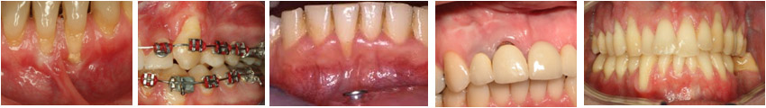 Recesion-gingival1.jpg