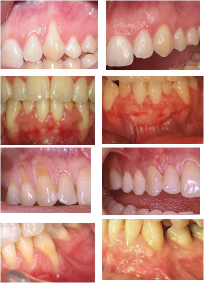 recesion-gingival.jpg